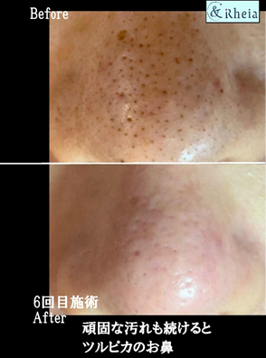 鼻毛穴改善